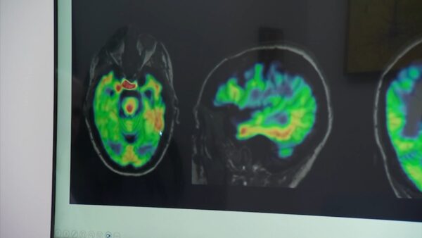 Houston healthcare employees work to treat patients and find cure for frontotemporal dementia disease
